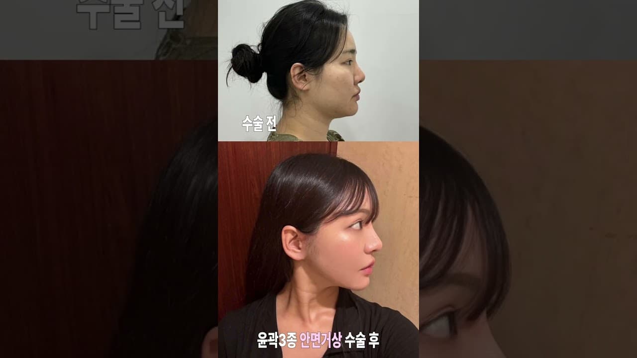 윤곽3종 1년차, 거상4개월차 경과🎀