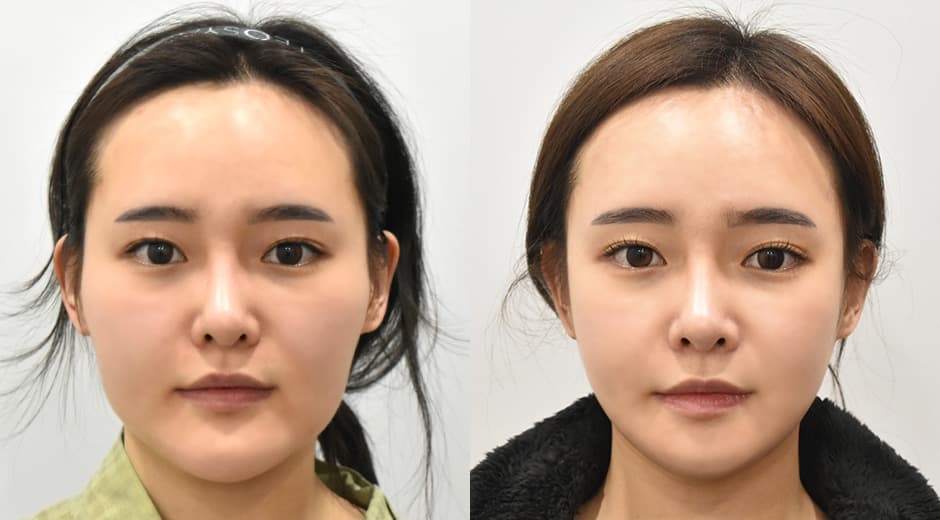 Cheekbone Reduction