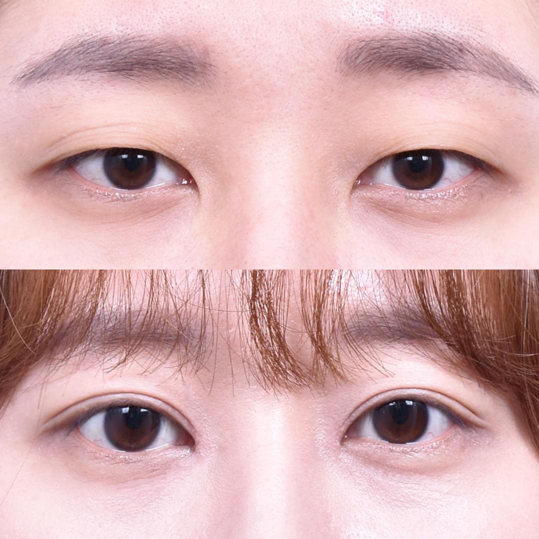 Non-Incisional Eye Lid Correction + Epicanthoplasty (1 Month Later)