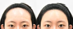 Forehead Reduction