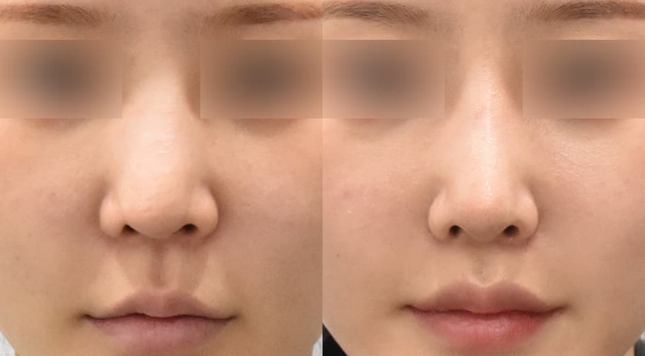 Lip Lift (Revision) · Philtrum-Nose