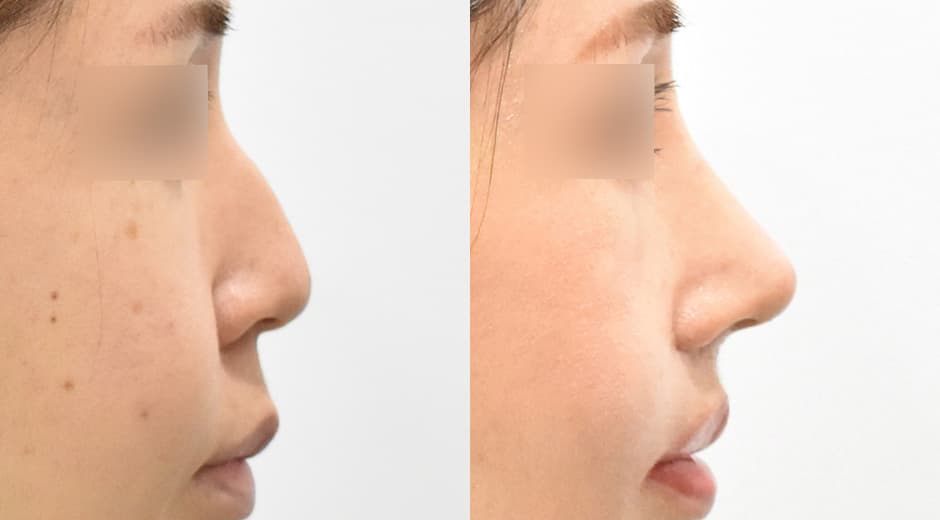 Lip Lift · Philtrum Reduction