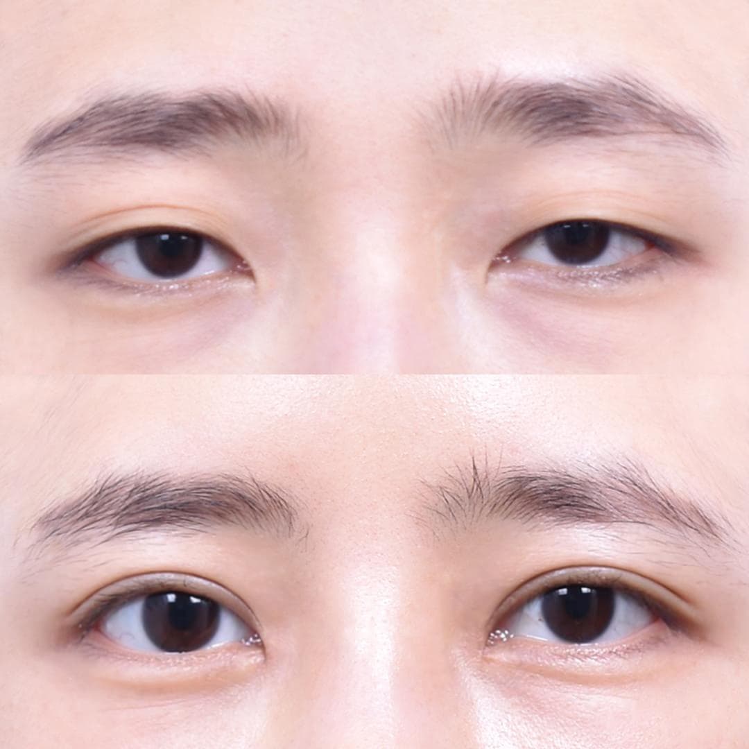 Non-Incisional Eye Lid Correction · Epicanthoplasty · Superior Epicanthoplasty (1 Month Post-Op) 1