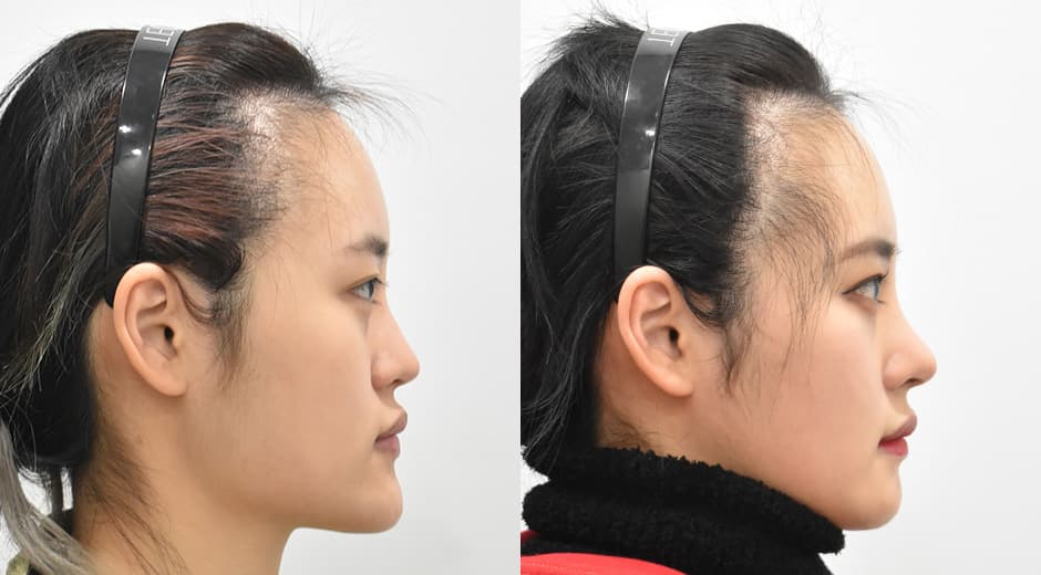 Square Jaw Reduction · Genioplasty