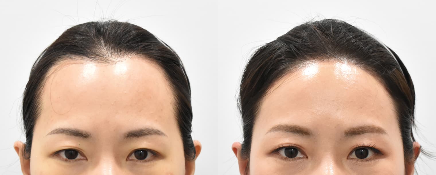 Forehead Reduction · M-shaped Hair Transplant