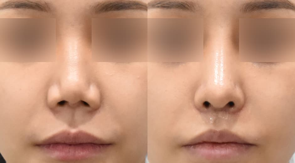 Lip Lift (Revision) · Philtrum-Nose
