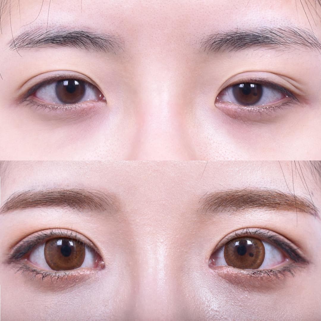 Non-Incisional Eye Lid Correction + Epicanthoplasty + Lateral Epicanthoplasty (3 Months Later)