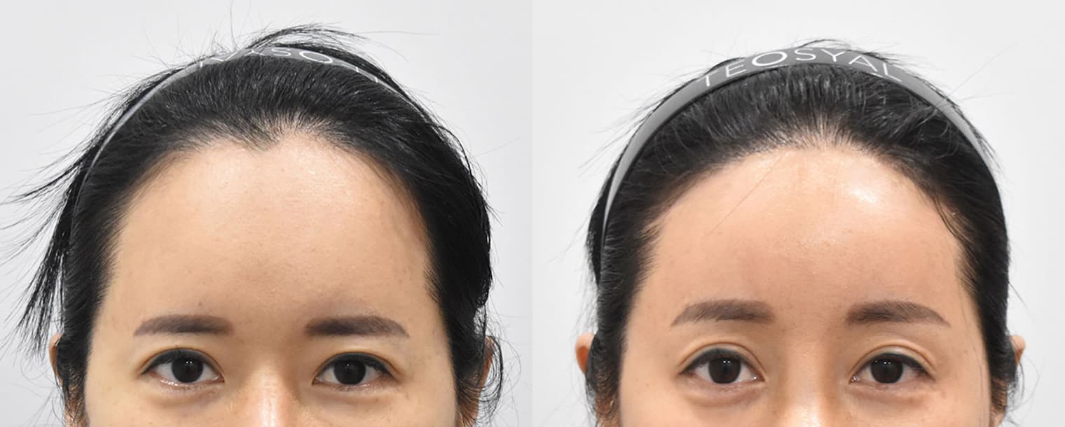 Forehead Reduction · Forehead Lift