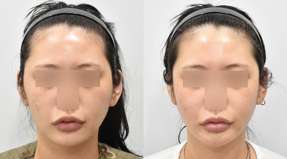 Cheekbone Reduction · Square Jaw Surgery · Genioplasty
