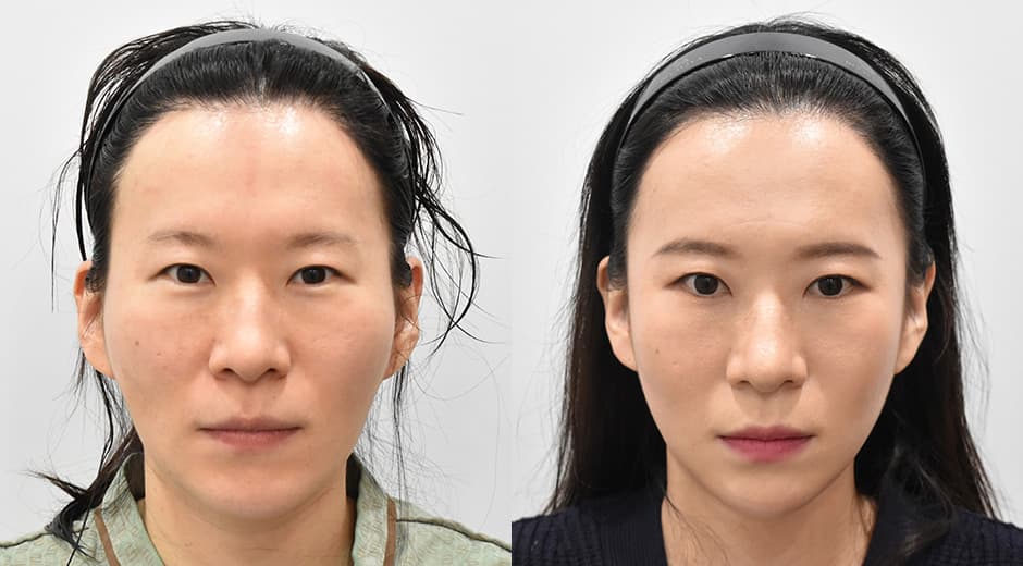Cheekbone Reduction