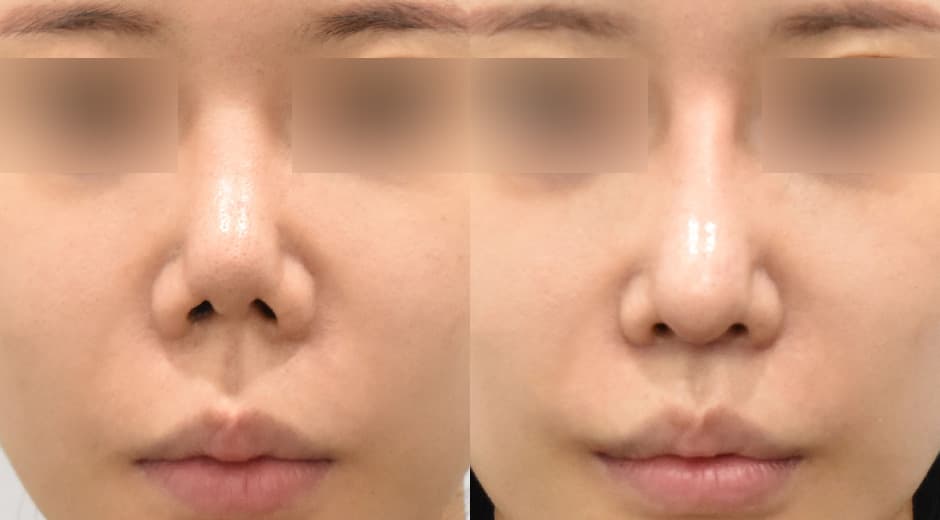 Lip Lift (Revision) · Philtrum-Nose