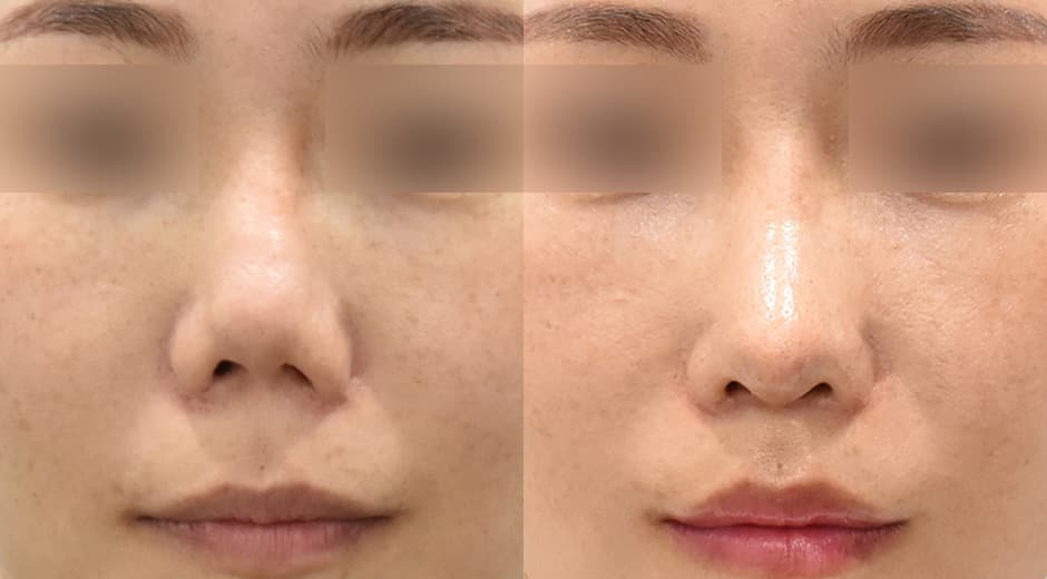 Lip Lift (Revision) · Philtrum-Nose 1