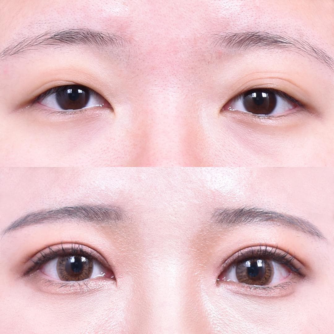 Non-Incisional Eye Lid Correction + Epicanthoplasty (After 1 month)