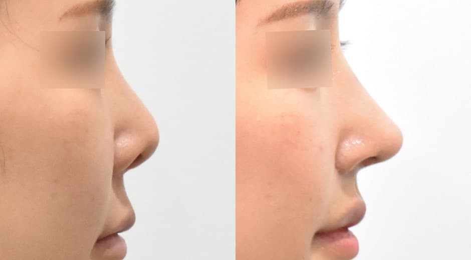 Lip Lift (Revision) · Philtrum-Nose