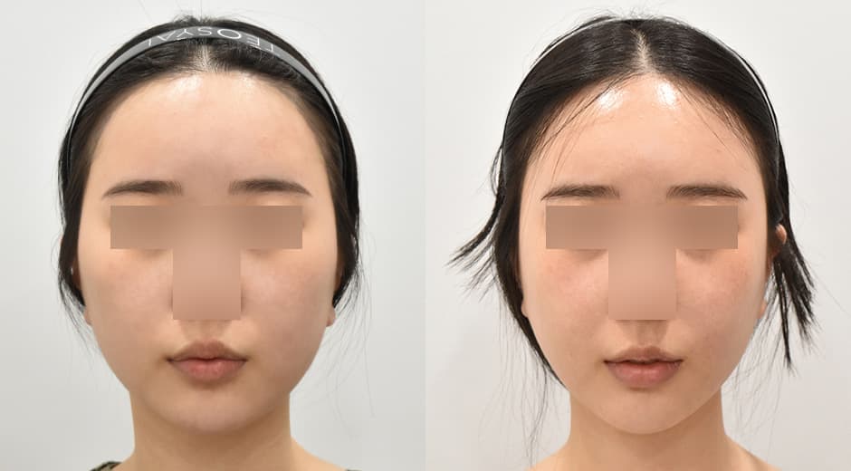 Cheekbone Reduction