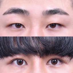 Non-incisional Double Eyelid · Epicanthoplasty (2 Weeks Post-op)