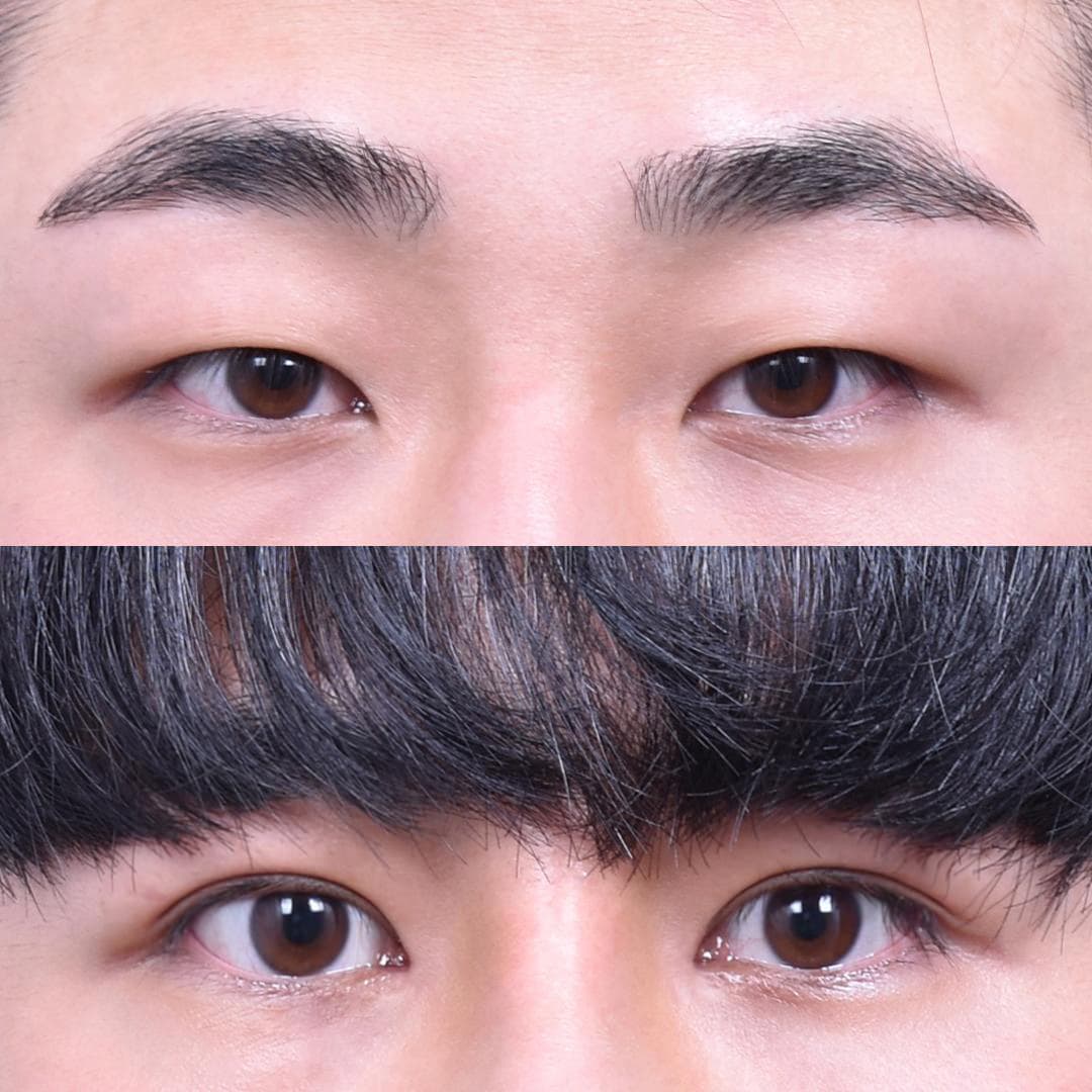 Non-incisional Double Eyelid · Epicanthoplasty (2 Weeks Post-op) 1