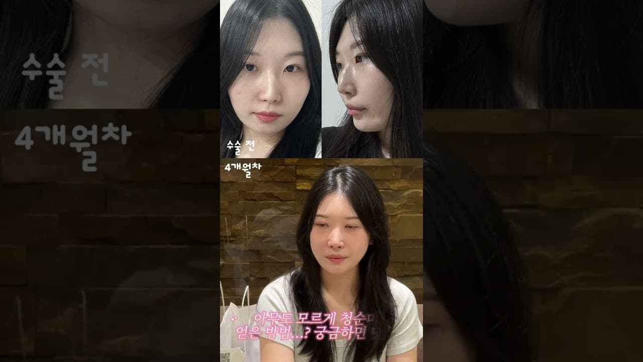 “처음 본 사람들은 수술한지 모를 정도로 자연스러워요”